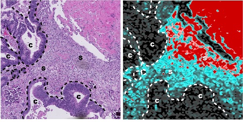 Imatge_tumor
