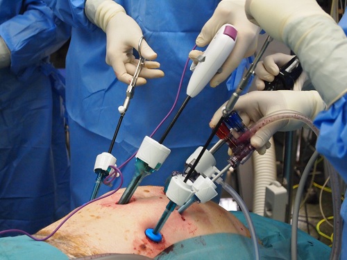 Gangli_sentinella_cancer_prostata