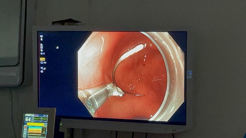 Nova_tecnica_digestiu_gastroparesia