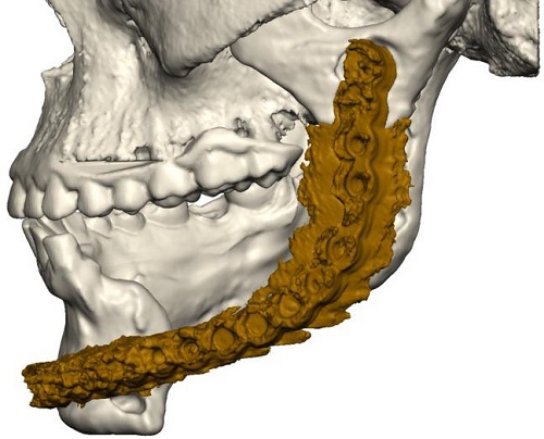 Reconstruccio_cirurgia_maxillofacial