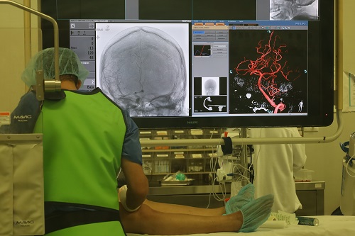 Stent_neuroangiografia