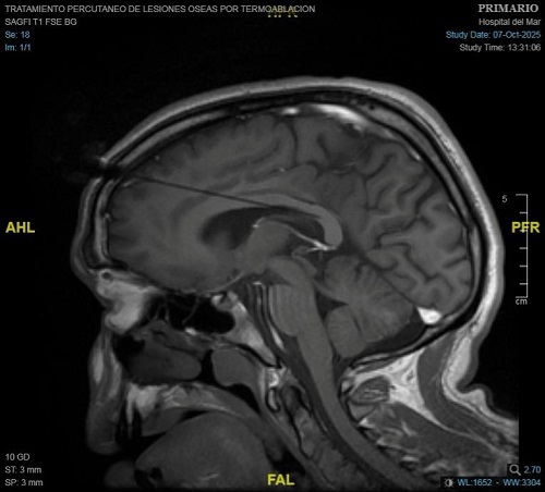 Callosotomia_epilepsia