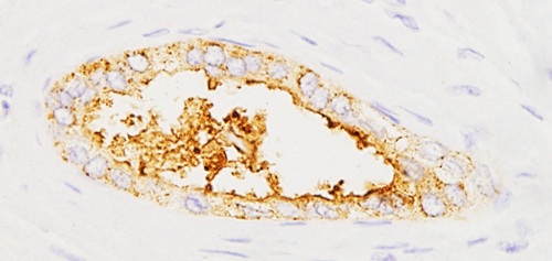 Cancer_pancrees