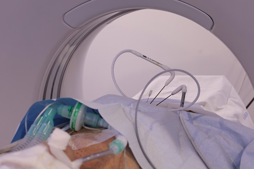 Crioablació_Tumors