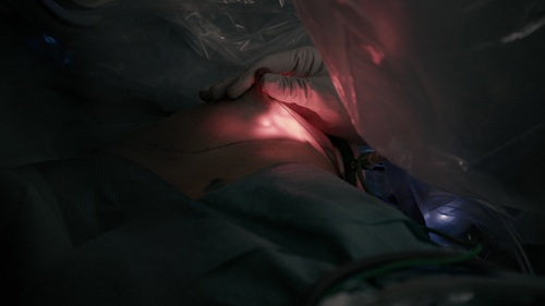 Mastectomia_robotica