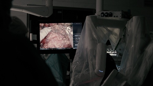 Mastectomia_robotica